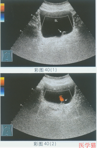 超声综合描述:膀胱三角区左输尿管开口处可见直径1