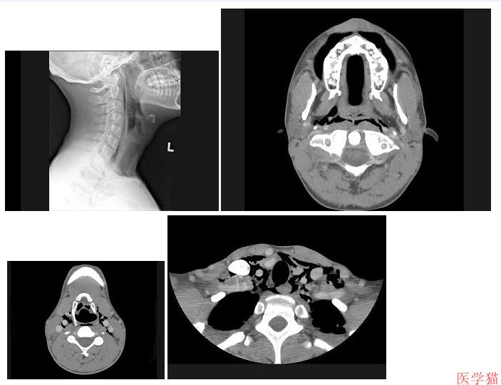 腺样体肥大CT图像图片