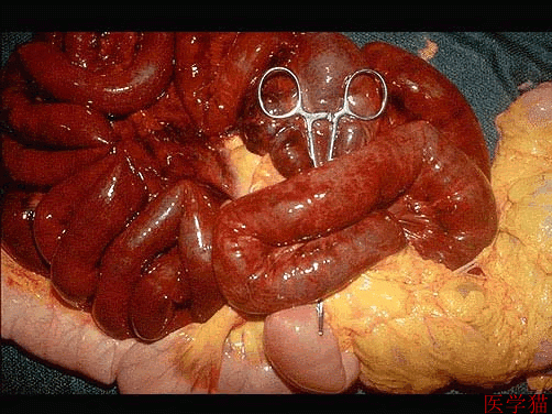 术中见部分小肠红褐色,肠管扭转成团,切除病变肠管