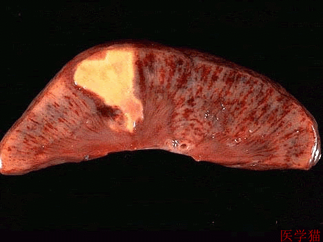 慢性肝淤血病理切片图片